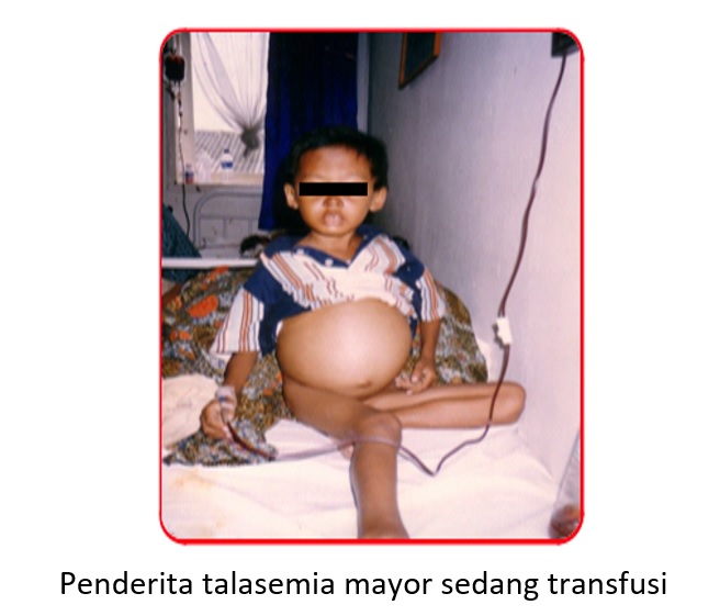 Penderita Talasemia Mayor sedang Transfusi