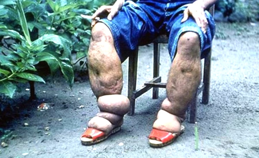 Cegah Penyebaran Penyakit Kaki Gajah atau Filariasis, Dinas Kesehatan Kutai Timur Kembali Lakukan Pengobatan Gratis