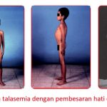 Ini Cara Cegah Talasemia Dengan Mengetahui Status Talasemia Anda