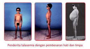 Ini Cara Cegah Talasemia Dengan Mengetahui Status Talasemia Anda