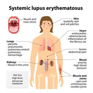 Systemic Lupus Erythematosus