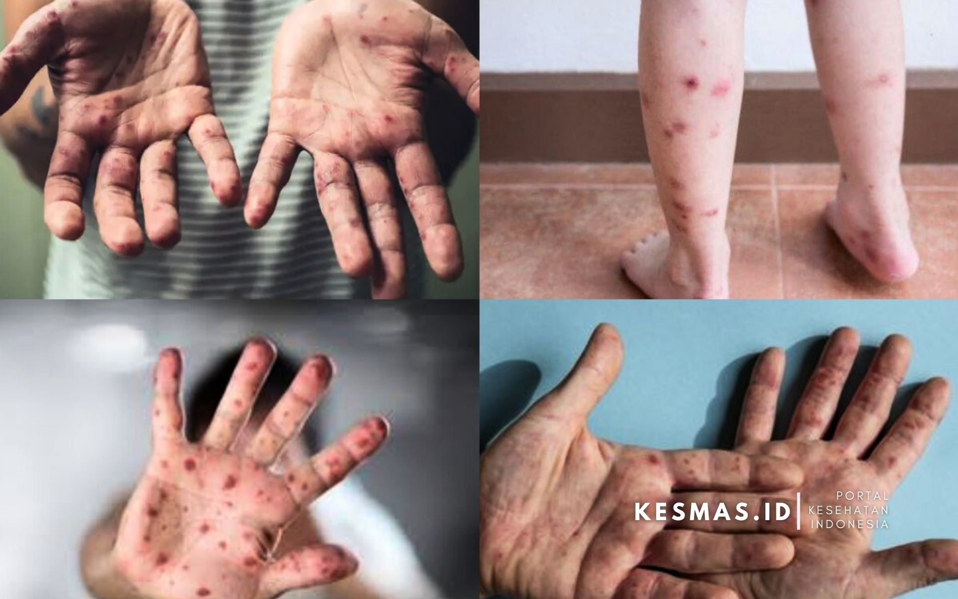 Flu Singapura Pada Anak, Kenali Gejala dan Cara Mencegahnya - Kesmas-ID.com