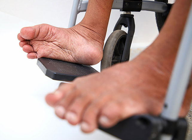 Kasus Polio Melonjak, Yuk, Kenali untuk Hindari!