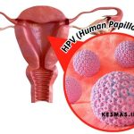 Siapa Saja yang Membutuhkan Vaksin HPV