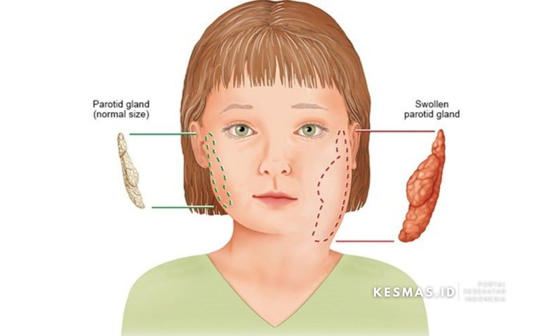 A to Z Penyakit Gondongan