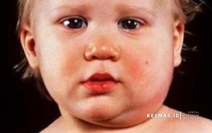 Penyakit Kelenjar Air Liur yang Perlu Dikenali