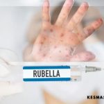 Kenali-Rubella-Campak-Jerman-Penularan-Pencegahan-dan-Pengobatannya.jpg