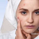 Mitos atau Fakta, Puasa Bisa Membantu Mengatasi Jerawat?